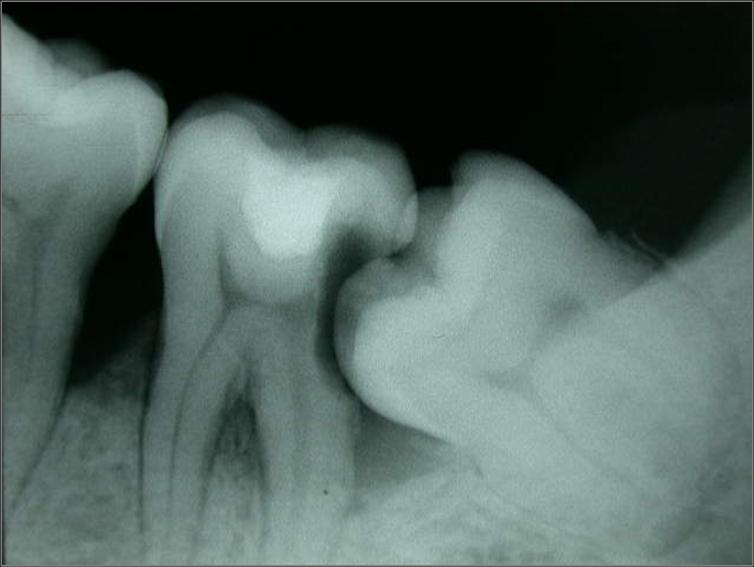 3rd molar-1.0